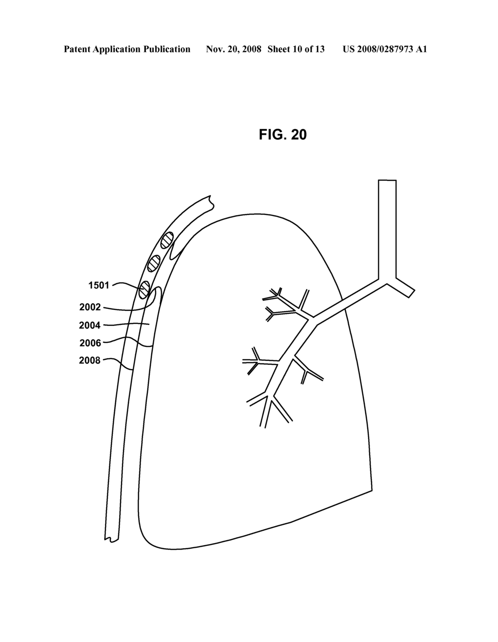 VARIABLE PARIETAL/VISCERAL PLEURAL COUPLING - diagram, schematic, and image 11