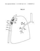 VARIABLE PARIETAL/VISCERAL PLEURAL COUPLING diagram and image