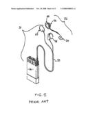 Hearing System Prostheses diagram and image