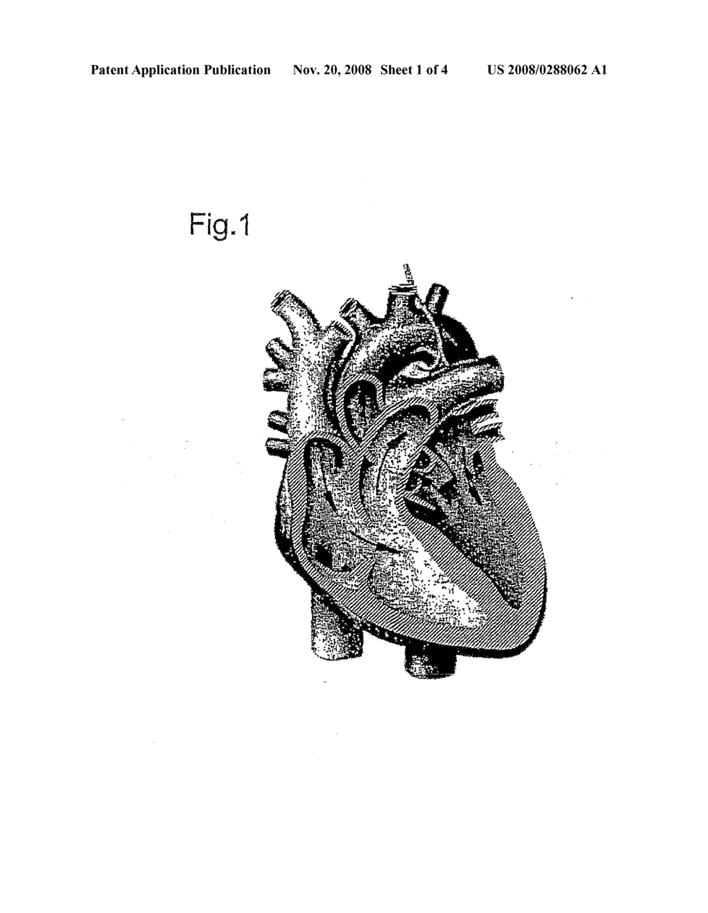DEVICE FOR SHRINKING OR REINFORCING THE VALVULAR ORIFICES OF THE HEART - diagram, schematic, and image 02