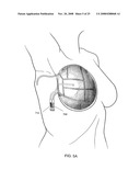 Methods and Devices for Breast Reconstruction diagram and image