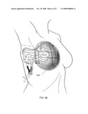 Methods and Devices for Breast Reconstruction diagram and image