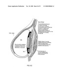 Methods and Devices for Breast Reconstruction diagram and image