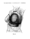 Methods and Devices for Breast Reconstruction diagram and image