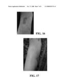 COMPOSITIONS AND METHODS FOR TREATMENT OF DERMAL SCARRING AND WRINKLING diagram and image
