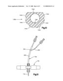 CATHETER POSITIONING APPARATUS diagram and image