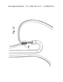 Surgical clip application assembly diagram and image