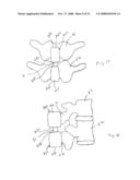 Spinous process implants and methods of using the same diagram and image