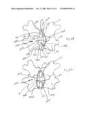 Spinous process implants and methods of using the same diagram and image