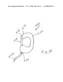 Spinous process implants and methods of using the same diagram and image