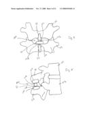 Spinous process implants and methods of using the same diagram and image