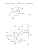 Spinous process implants and methods of using the same diagram and image