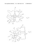 Spinous process implants and methods of using the same diagram and image