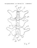 Spinous process implants and methods of using the same diagram and image