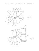 Spinous process implants and methods of using the same diagram and image