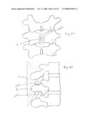 Spinous process implants and methods of using the same diagram and image