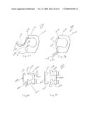 Spinous process implants and methods of using the same diagram and image