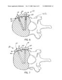 Anterior Adherent Thoracolumbar Spine Plate diagram and image