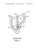 LOCATION, TIME, AND/OR PRESSURE DETERMINING DEVICES, SYSTEMS, AND METHODS FOR DEPLOYMENT OF LESION-EXCLUDING HEART IMPLANTS FOR TREATMENT OF CARDIAC HEART FAILURE AND OTHER DISEASE STATES diagram and image