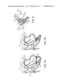 LOCATION, TIME, AND/OR PRESSURE DETERMINING DEVICES, SYSTEMS, AND METHODS FOR DEPLOYMENT OF LESION-EXCLUDING HEART IMPLANTS FOR TREATMENT OF CARDIAC HEART FAILURE AND OTHER DISEASE STATES diagram and image