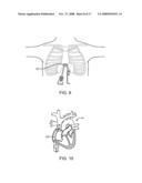 LOCATION, TIME, AND/OR PRESSURE DETERMINING DEVICES, SYSTEMS, AND METHODS FOR DEPLOYMENT OF LESION-EXCLUDING HEART IMPLANTS FOR TREATMENT OF CARDIAC HEART FAILURE AND OTHER DISEASE STATES diagram and image