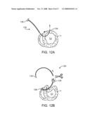 LOCATION, TIME, AND/OR PRESSURE DETERMINING DEVICES, SYSTEMS, AND METHODS FOR DEPLOYMENT OF LESION-EXCLUDING HEART IMPLANTS FOR TREATMENT OF CARDIAC HEART FAILURE AND OTHER DISEASE STATES diagram and image