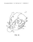 LOCATION, TIME, AND/OR PRESSURE DETERMINING DEVICES, SYSTEMS, AND METHODS FOR DEPLOYMENT OF LESION-EXCLUDING HEART IMPLANTS FOR TREATMENT OF CARDIAC HEART FAILURE AND OTHER DISEASE STATES diagram and image