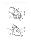 LOCATION, TIME, AND/OR PRESSURE DETERMINING DEVICES, SYSTEMS, AND METHODS FOR DEPLOYMENT OF LESION-EXCLUDING HEART IMPLANTS FOR TREATMENT OF CARDIAC HEART FAILURE AND OTHER DISEASE STATES diagram and image