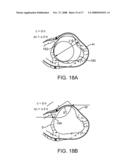 LOCATION, TIME, AND/OR PRESSURE DETERMINING DEVICES, SYSTEMS, AND METHODS FOR DEPLOYMENT OF LESION-EXCLUDING HEART IMPLANTS FOR TREATMENT OF CARDIAC HEART FAILURE AND OTHER DISEASE STATES diagram and image