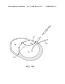 LOCATION, TIME, AND/OR PRESSURE DETERMINING DEVICES, SYSTEMS, AND METHODS FOR DEPLOYMENT OF LESION-EXCLUDING HEART IMPLANTS FOR TREATMENT OF CARDIAC HEART FAILURE AND OTHER DISEASE STATES diagram and image