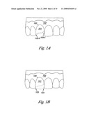 Tooth modeling diagram and image