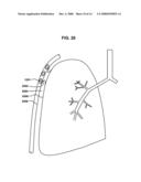 BRIDGE ELEMENT FOR LUNG IMPLANT diagram and image