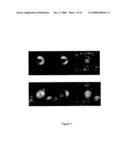 Precision subtraction computed tomographic angiography diagram and image