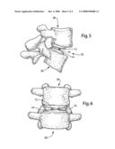INTERVERTEBRAL IMPLANT COMPONENT WITH THREE POINTS OF CONTACT diagram and image