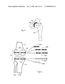 MAGNETIC JOINT IMPLANT diagram and image