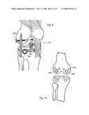 MAGNETIC JOINT IMPLANT diagram and image