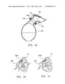 Ventricular Assist Device diagram and image