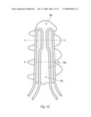 Suture Anchor diagram and image