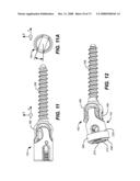 DEFLECTION ROD SYSTEM FOR A DYNAMIC STABILIZATION AND MOTION PRESERVATION SPINAL IMPLANTATION SYSTEM AND METHOD diagram and image