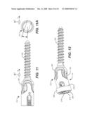 REVISION SYSTEM FOR A DYNAMIC STABILIZATION AND MOTION PRESERVATION SPINAL IMPLANTATION SYSTEM AND METHOD diagram and image