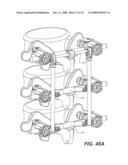 REVISION SYSTEM FOR A DYNAMIC STABILIZATION AND MOTION PRESERVATION SPINAL IMPLANTATION SYSTEM AND METHOD diagram and image