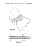 Interlocking buttress material retention system diagram and image