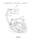 Methods and systems for implantably monitoring external breathing therapy diagram and image