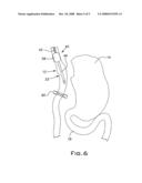 Method and Apparatus for Performing Gastric Bypass Surgery diagram and image