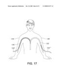 EXPANDABLE DIALYSIS APPARATUS AND METHOD diagram and image