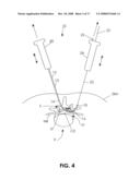 DEVICES AND METHODS FOR MEASURING THE SPACE AROUND A NERVE ROOT diagram and image