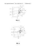 DEVICES AND METHODS FOR MEASURING THE SPACE AROUND A NERVE ROOT diagram and image