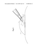 Lens Injector Lumen Tip for Wound Assisted Delivery diagram and image