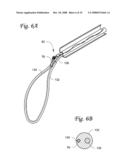 LEFT ATRIAL APPENDAGE CLOSURE diagram and image