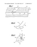 Apparatus and Method for Closing an Opening in a Blood Vessel Using Memory Metal and Collagen diagram and image